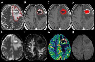 Peritumoral Brain Edema in Metastases May Be Related to Glymphatic Dysfunction